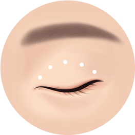 비절개 눈매교정