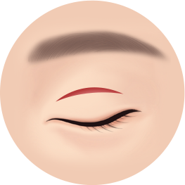 절개 눈매교정